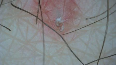 Ingrown Hairs at the microscope Stock Photos