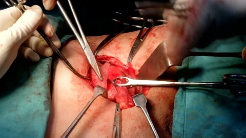 Inguinal Hernia operation using Mesh Stock Footage 131788908