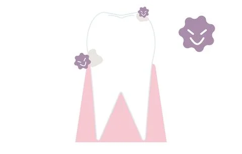 Initial stage of caries, cloudy surface Illustrazione stock