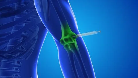 Injecting stem cells into a human elbow joint Stock Illustration