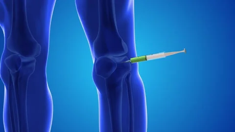 Injecting stem cells into a human knee Stock Footage 251696162