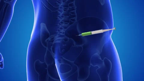 Injecting stem cells into a human pelvis Stock Footage 251842058