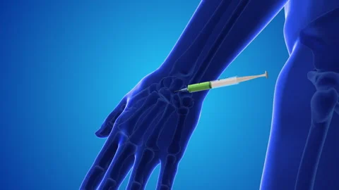 Injecting stem cells into a human wrist Stock Footage 251848728
