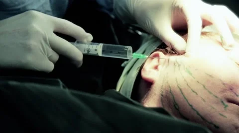 Injection of the face Stock Footage 55671851