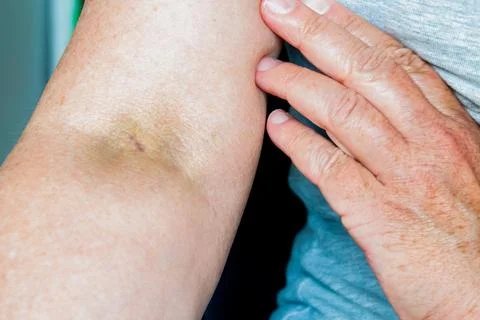 An injection mark in a vein on the arm of an elderly woman.. Stock Photos