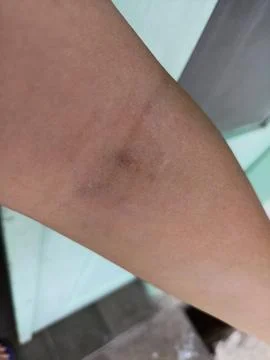 Injection marks on hands. Stock Photos