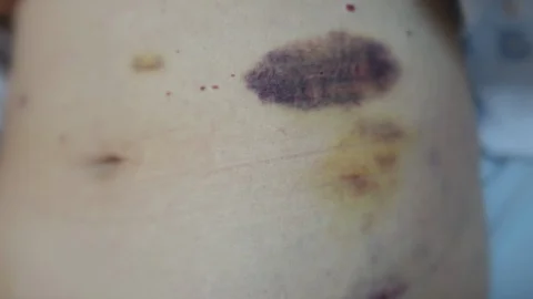 Injection under skin bleeding Vídeo Stock 101535136