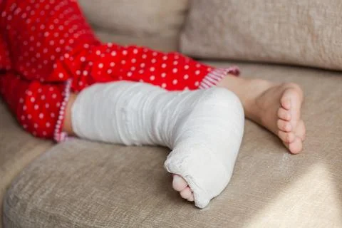 Injured leg of an unrecognizable girl in a cast lying on the sofa at home Stock Photos