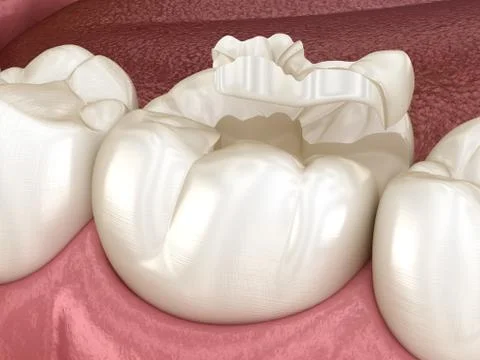 Inlay ceramic crown fixation over tooth. Medically accurate 3D illustration o Stock Illustration