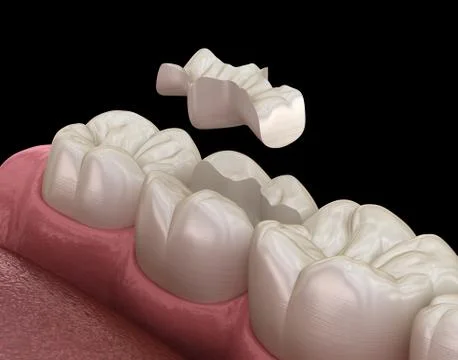 Inlay ceramic crown fixation over tooth. Medically accurate 3D illustration o Stock Illustration