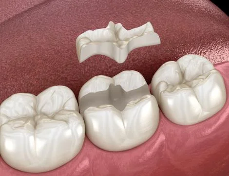 Inlay ceramic crown fixation over tooth. Medically accurate 3D illustration o イラスト素材