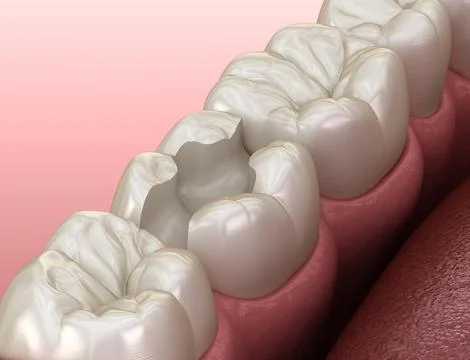 Inlay ceramic crown fixation over tooth. Medically accurate 3D illustration o Stock Illustration