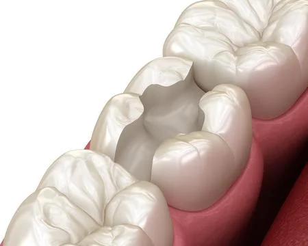 Inlay ceramic crown installation in to the tooth. Medically accurate 3D Ilustração Stock