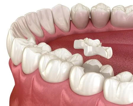 Inlay ceramic crown installation in to the tooth. Medically accurate 3D Stock Illustration