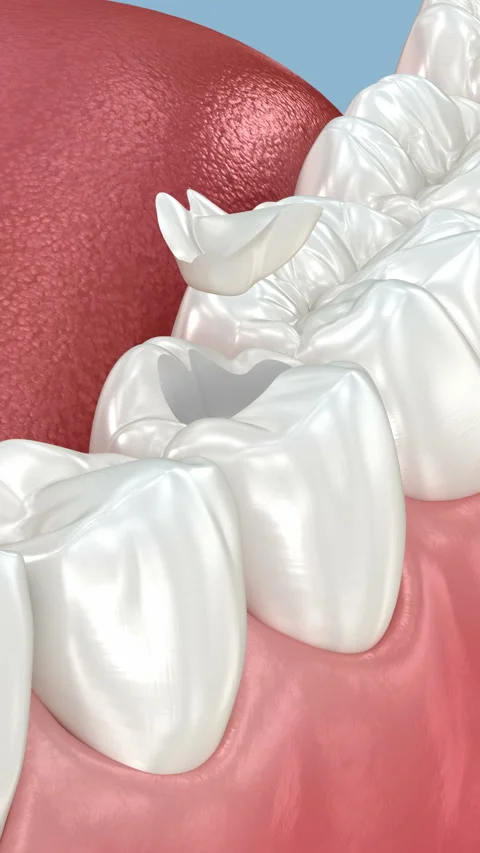 Inlay ceramic crown placement. 3D animation Stock Footage 314537655