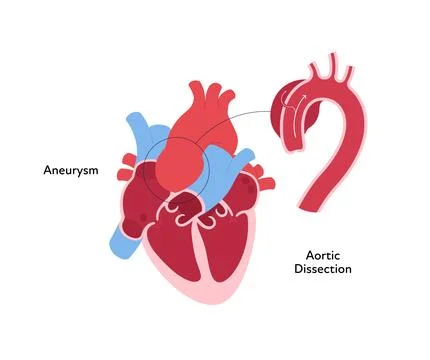 Inner organ cross section with aortic aneurism Stock Illustration