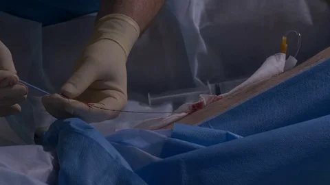 An innovative method of varicose veins surgery, close-up shot of patient legs 库存影片 73575600