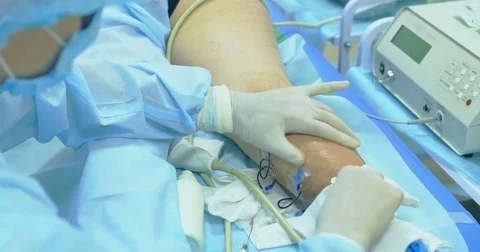 Innovative method of varicose veins surgery, sclerotherapy procedure. Close-up Stock Footage 82939620