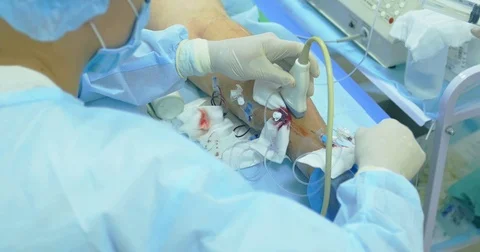 Innovative method of varicose veins surgery, sclerotherapy procedure. Close-up Stock Footage 83037773