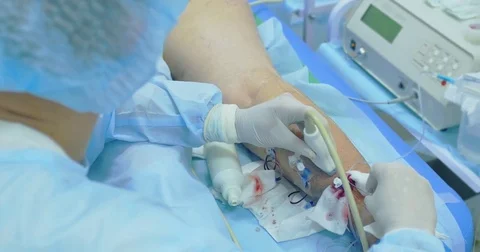 Innovative method of varicose veins surgery, sclerotherapy procedure. Close-up Stock Footage 83086751