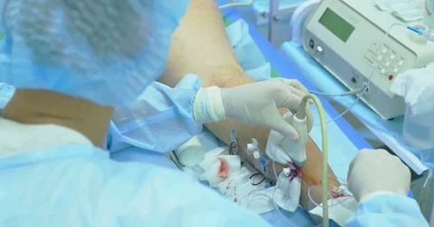 Innovative method of varicose veins surgery, sclerotherapy procedure. Close-up Stock Footage 83089064