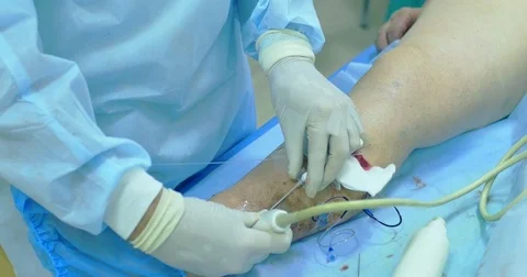 Innovative method of varicose veins surgery, sclerotherapy procedure. Close-up Stock Footage 83089106