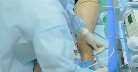 Innovative method of varicose veins surgery, sclerotherapy procedure. Close-up Stock Footage 83401309