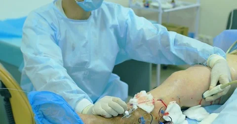 Innovative method of varicose veins surgery, sclerotherapy procedure. Close-up Stock Footage 83402133