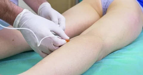 Innovative method of varicose veins surgery, sclerotherapy procedure. Close-up Stock Footage 102173101