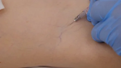 Innovative method of varicose veins surgery, sclerotherapy procedure Stock Footage 107384511