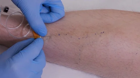Innovative method of varicose veins surgery, sclerotherapy procedure. Stock Footage 107603783