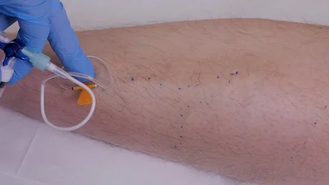 Innovative method of varicose veins surgery, sclerotherapy procedure. Video stock 107603910