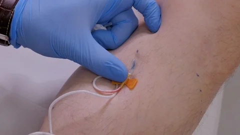 Innovative method of varicose veins surgery, sclerotherapy procedure. Stock Footage 107603929