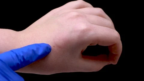 Insect bite close up. Doctor in blue medical glove inspect bite site Stock Footage 106581704
