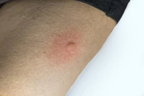 Insect bite on the human leg Stock Photos