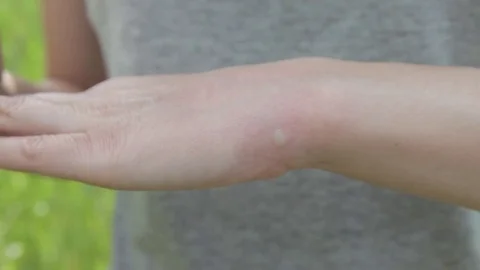 Insect bite, mosquito, tick. Irritation. The girl scratches her arm. Stock Footage 76426731