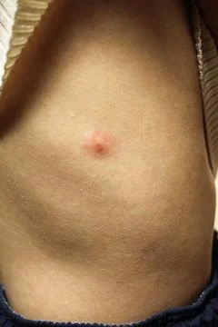 Insect bite Stock Photos