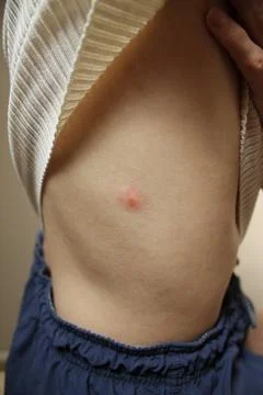Insect bite Stock Photos