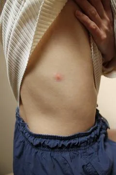 Insect bite Stock Photos