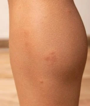 Insect bite on skin as background. Stock Photos
