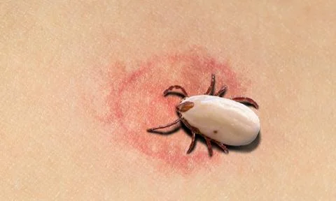 Insect bite symptoms and recommendations Stock-Fotos