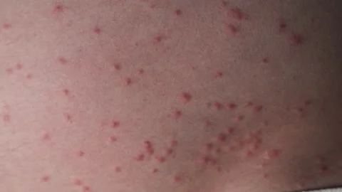 Insect bites, allergic reaction. Macro shot of the abdomen showcasing a Video stock 244453094
