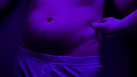 Insect bites and an allergic reaction visible in the abdominal area. The Video stock 244698162