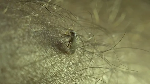 Insect macro 4k: Common bedbug parasite  on human skin in bed at night Vídeos de archivo 80331540