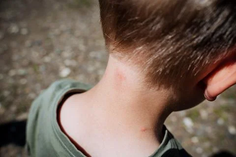 Insects bit the boy in the neck, bite marks from a midge, red dots on the child Stock Photos