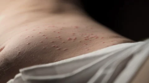 Insects bit while the person was asleep, resulting in multiple bite marks. Video stock 244453042