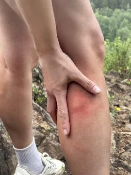 Insects bit a womans leg while hiking. Red bite site, itching, swelling Stock Photos