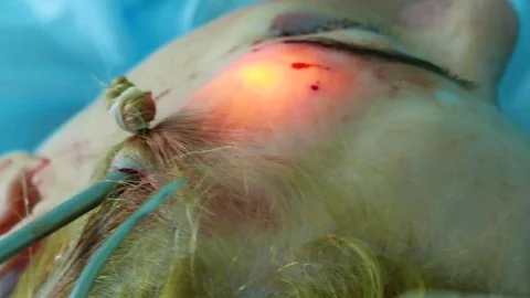 Inserting into a small hole in the patient's head an endoscope, the doctor separ Stock Footage 72565633