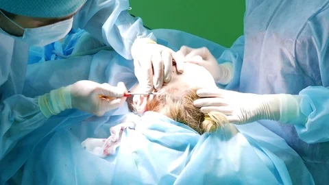 Inserting into the small hole in the patient's head an instrument, the doctor se 스톡 동영상 72566162