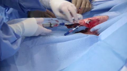 Inserting Syringe in Laparoscopy Tube Stock-Footage 62805891